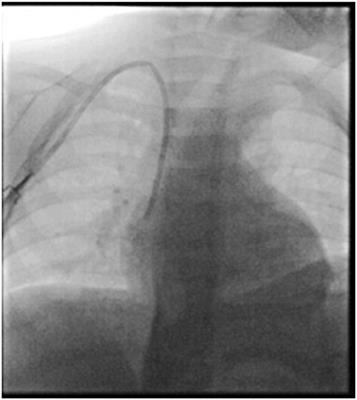 Case report: Bilateral pleural effusion secondary to late migration of a tunneled central venous catheter in a patient affected by high risk neuroblastoma